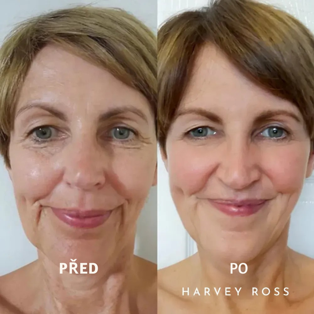 Yuma Beauty - Harvey ross kamžitý lifting