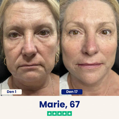 Yuma Beauty™ Lift : Rozlučte se se svým podbradkem ještě dnes.