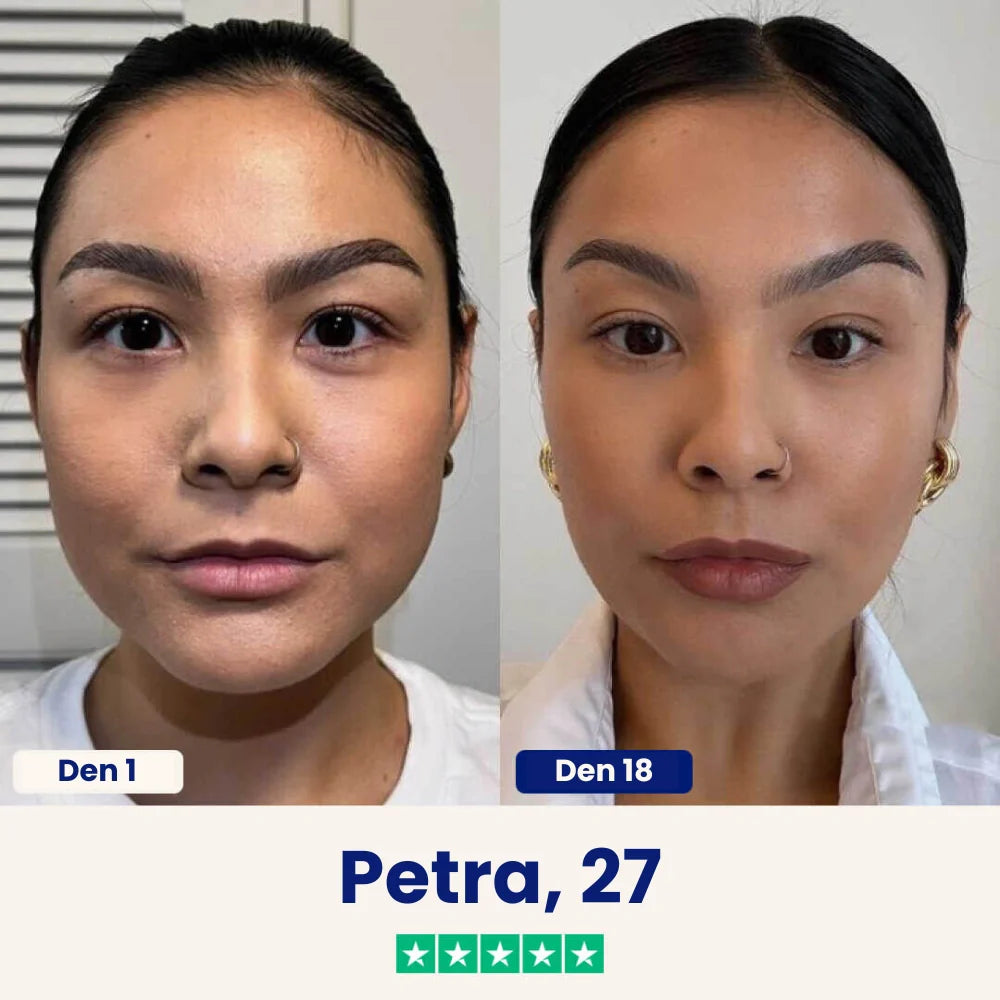 Yuma Beauty™ Lift : Rozlučte se se svým podbradkem ještě dnes.